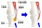 osgood_schlatter_01